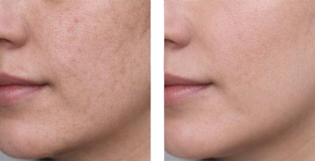 Before and after DUOVIVE dual-wavelength laser resurfacing treatment showing improved skin texture and tone